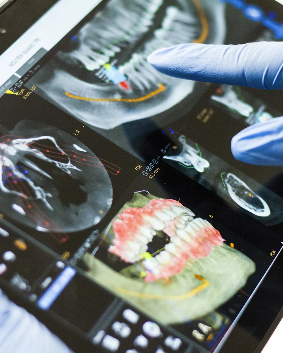 A gloved hand pointing at a 3D dental scan on a tablet