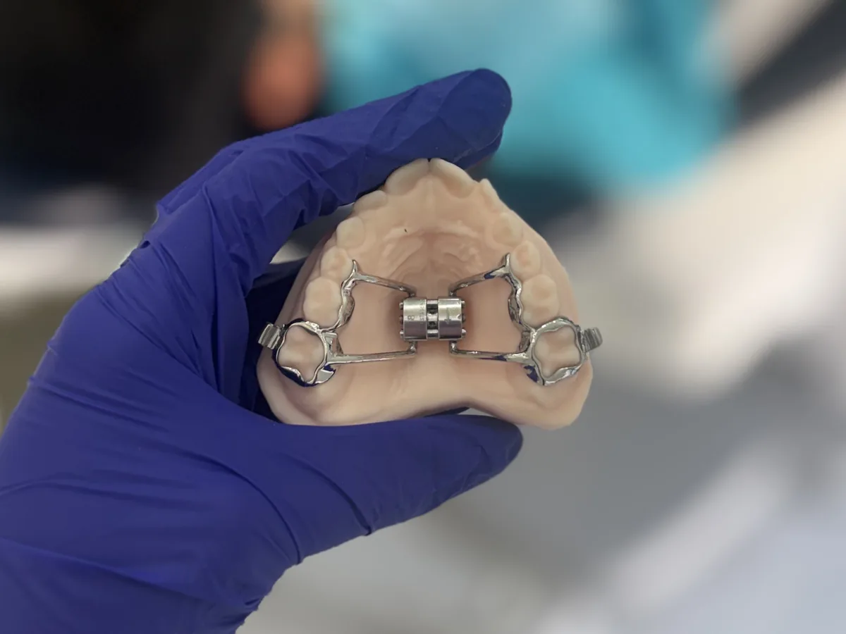 A fixed palatal expander on a dental model, held in Dr Amna's clinic