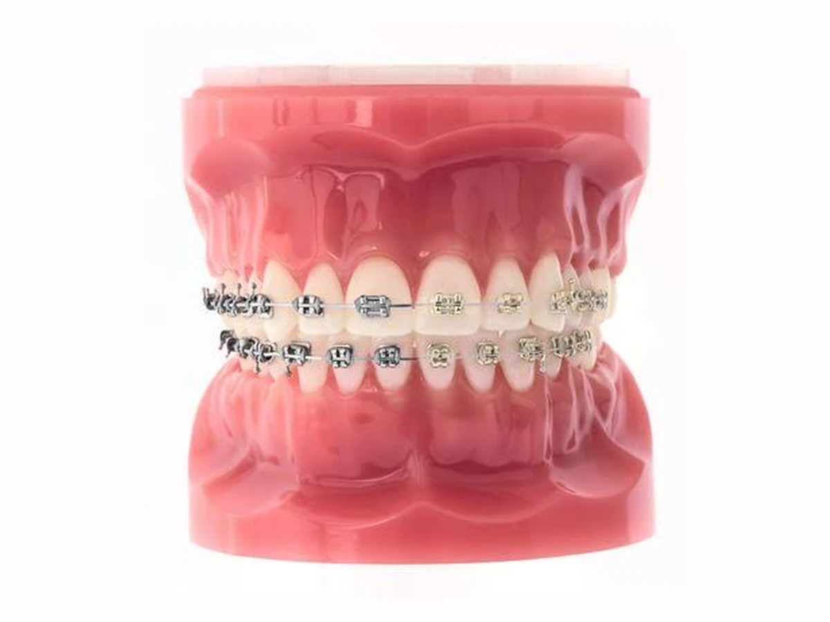 Metal braces on a teaching model