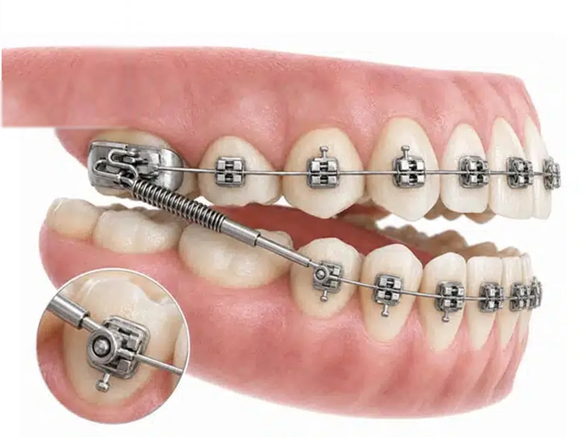 A fixed Class II corrector, a spring connecting the upper and lower braces