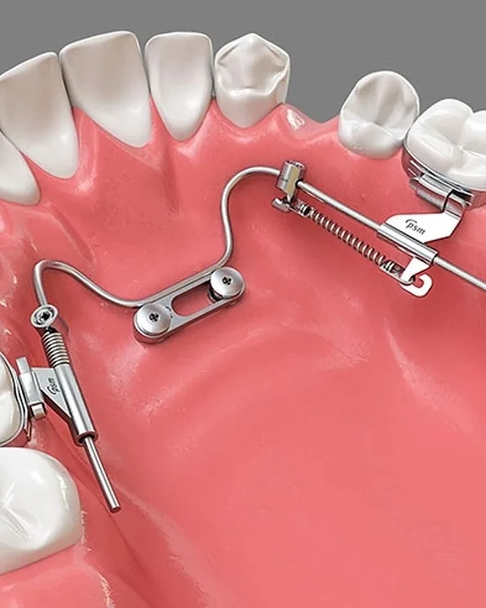 An intraoral distalizer on a model of the upper teeth