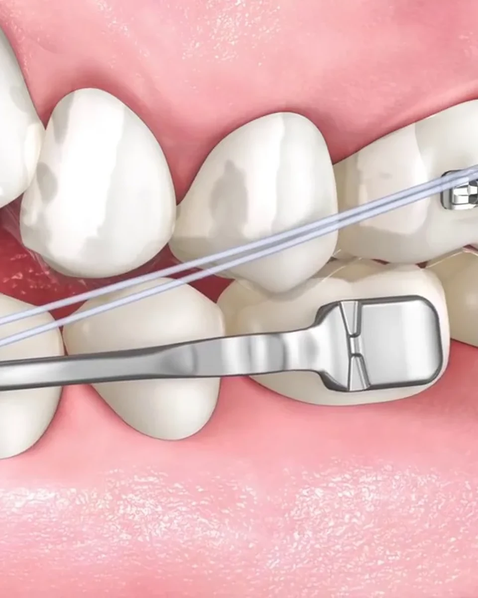 A fixed Class III corrector with elastics between the upper and lower teeth