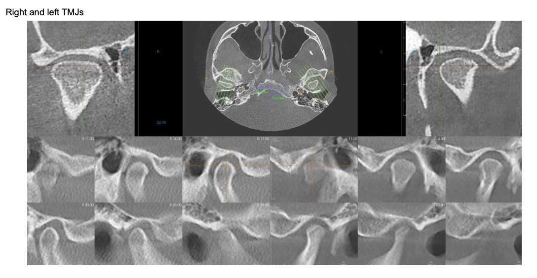CBCT scan views of the right and left jaw joints (TMJs)