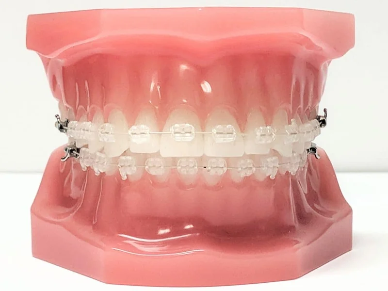 Tooth-coloured ceramic braces on a teaching model in Dr Amna's clinic