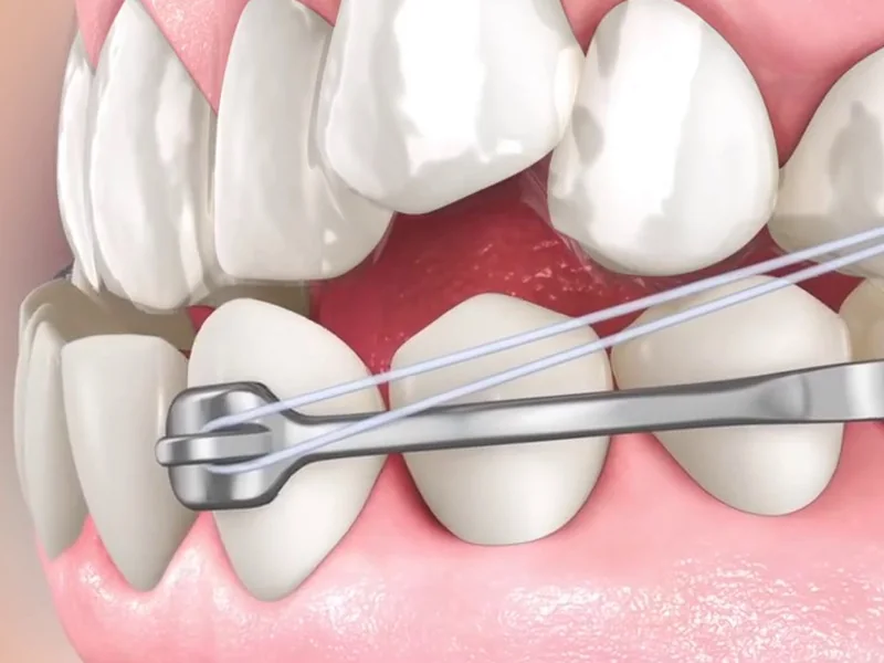 A fixed Class III corrector with an elastic attached to the lower braces