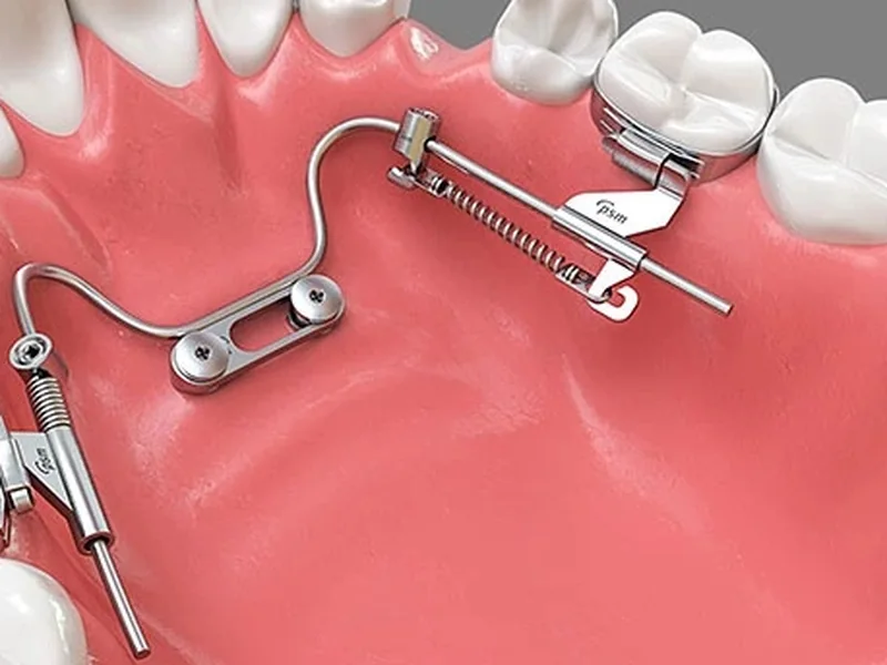 An intraoral distalizer: springs that move the upper back teeth backwards