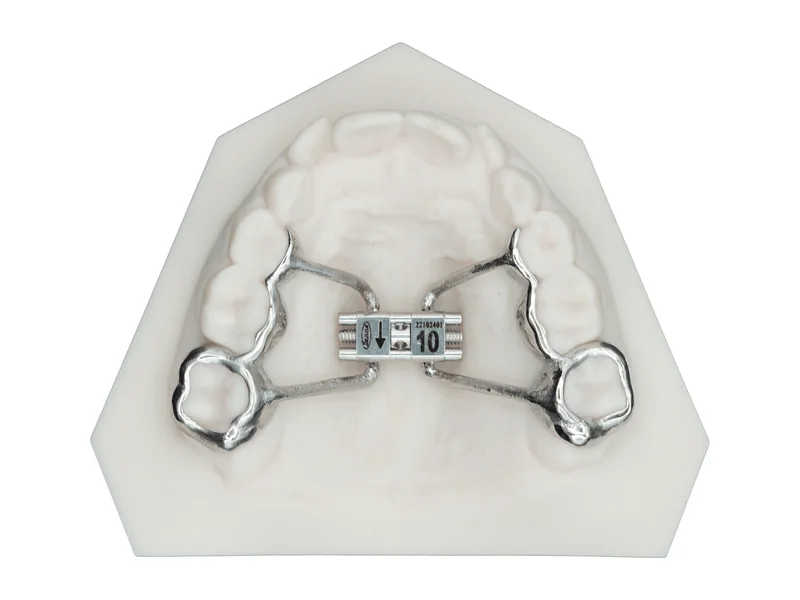 A 3D-printed metal palatal expander on a model of the upper teeth