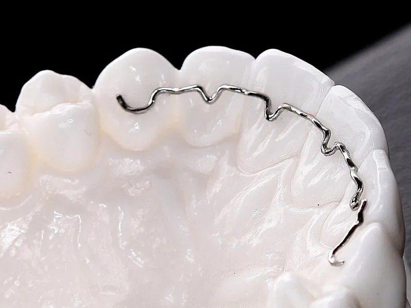 A fixed retainer wire bonded behind the front teeth of a dental model
