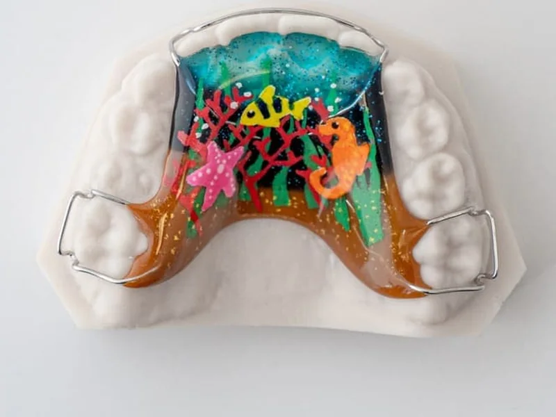 A Hawley retainer with a hand-painted sea scene in the acrylic