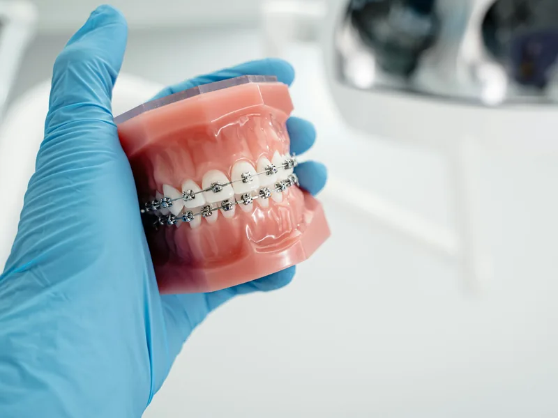 Metal braces on a teaching model