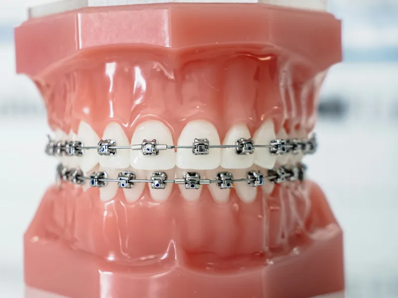 Self-ligating brackets holding the wire without elastic ties